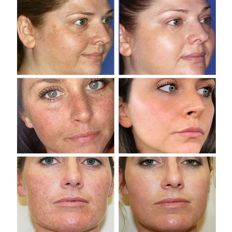 Crema blanqueadora para pecas, - Charcoal Whitening Paste reseña y precio