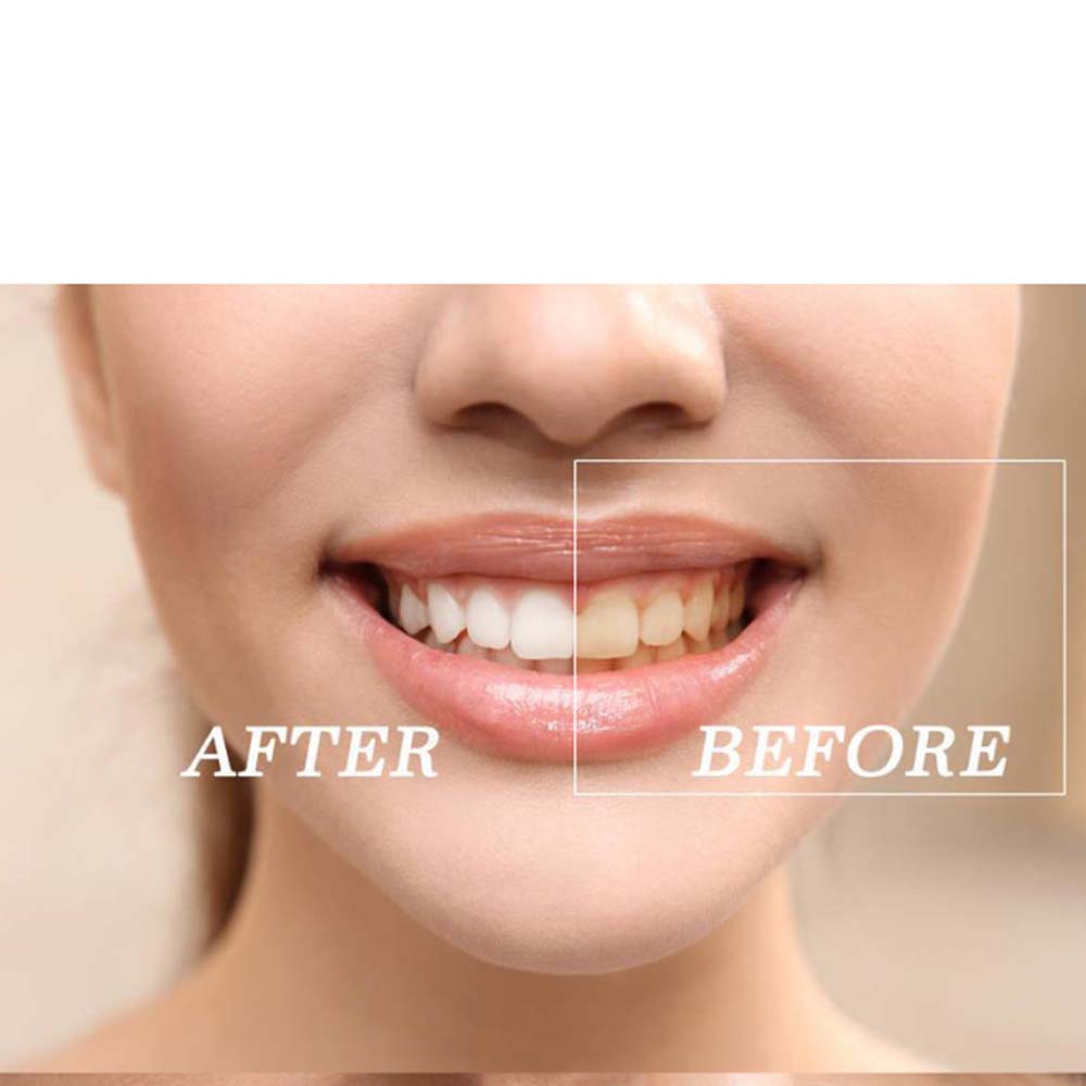 Kit de Gel blanqueador de dien - Teeth Whitening Gels reseña y precio