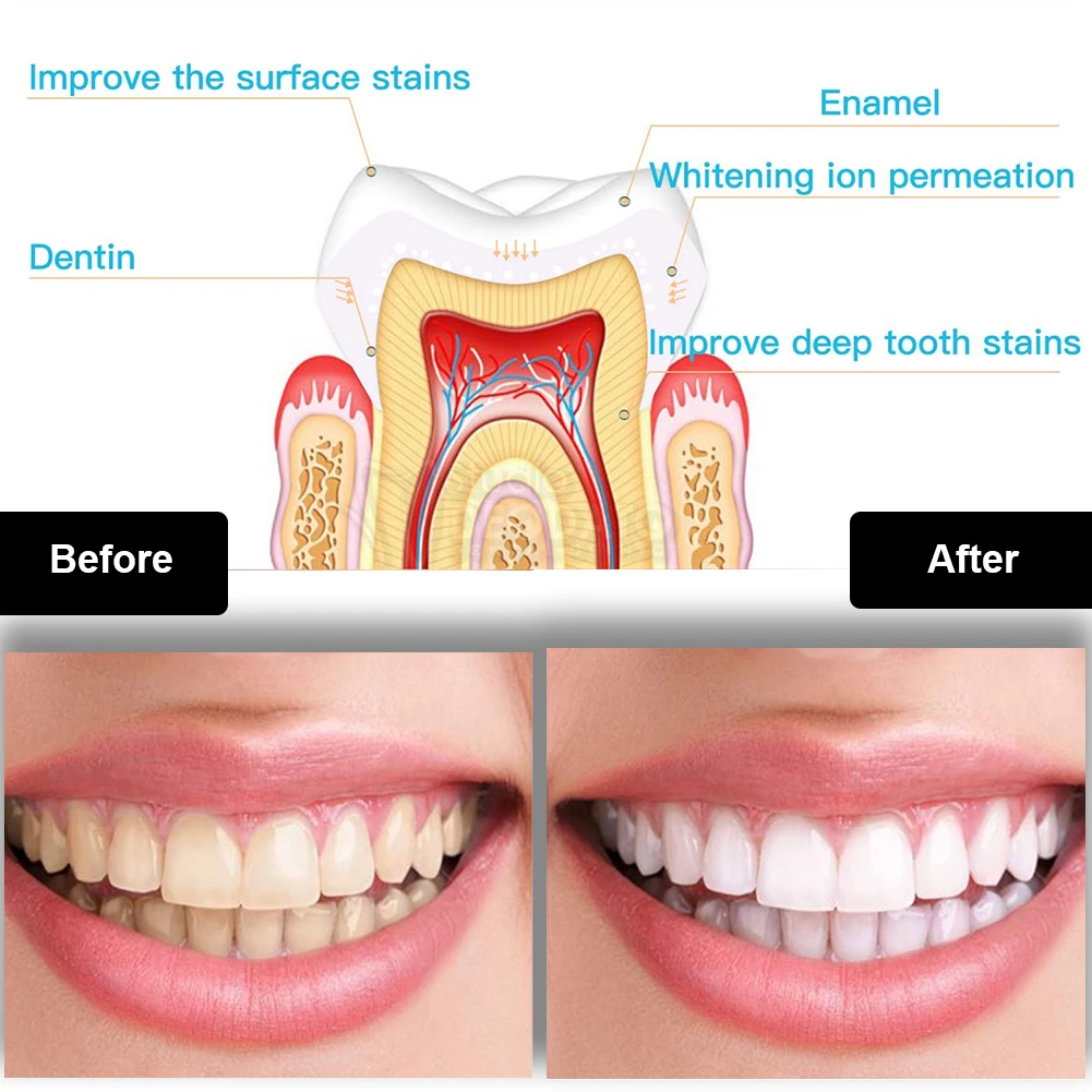Kit de blanqueamiento Dental M - Teeth Whitening Gels reseña y precio